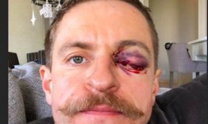 Michael Grabner shows gory eye day after taking stick to face